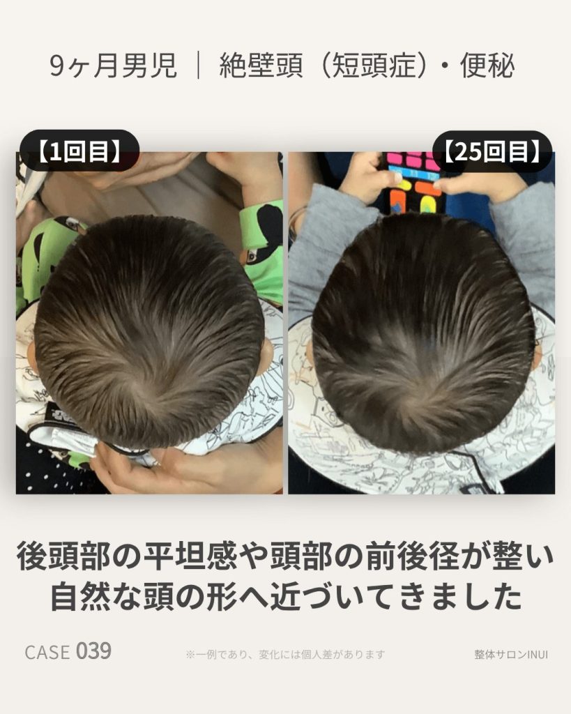 生後9ヶ月男児の絶壁頭ビフォーアフター比較