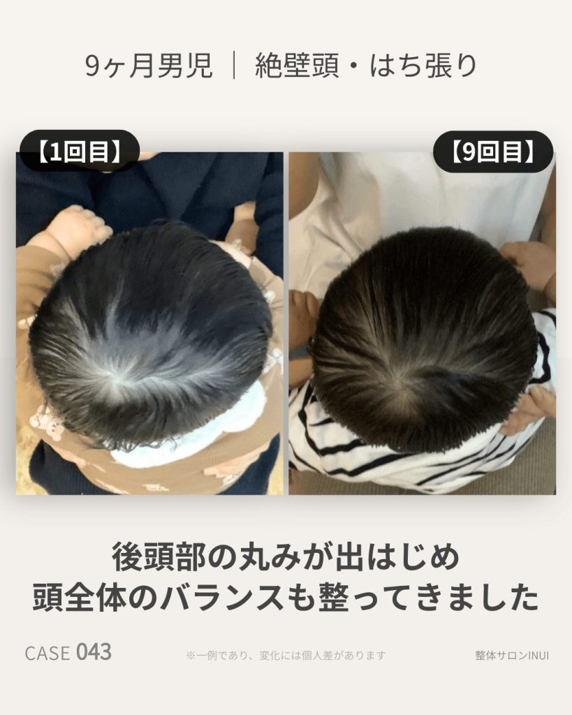 生後9ヶ月男児の絶壁頭ビフォーアフター比較