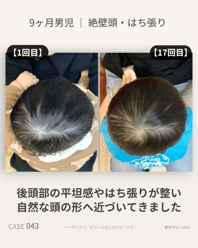 生後9ヶ月男児の絶壁頭ビフォーアフター比較