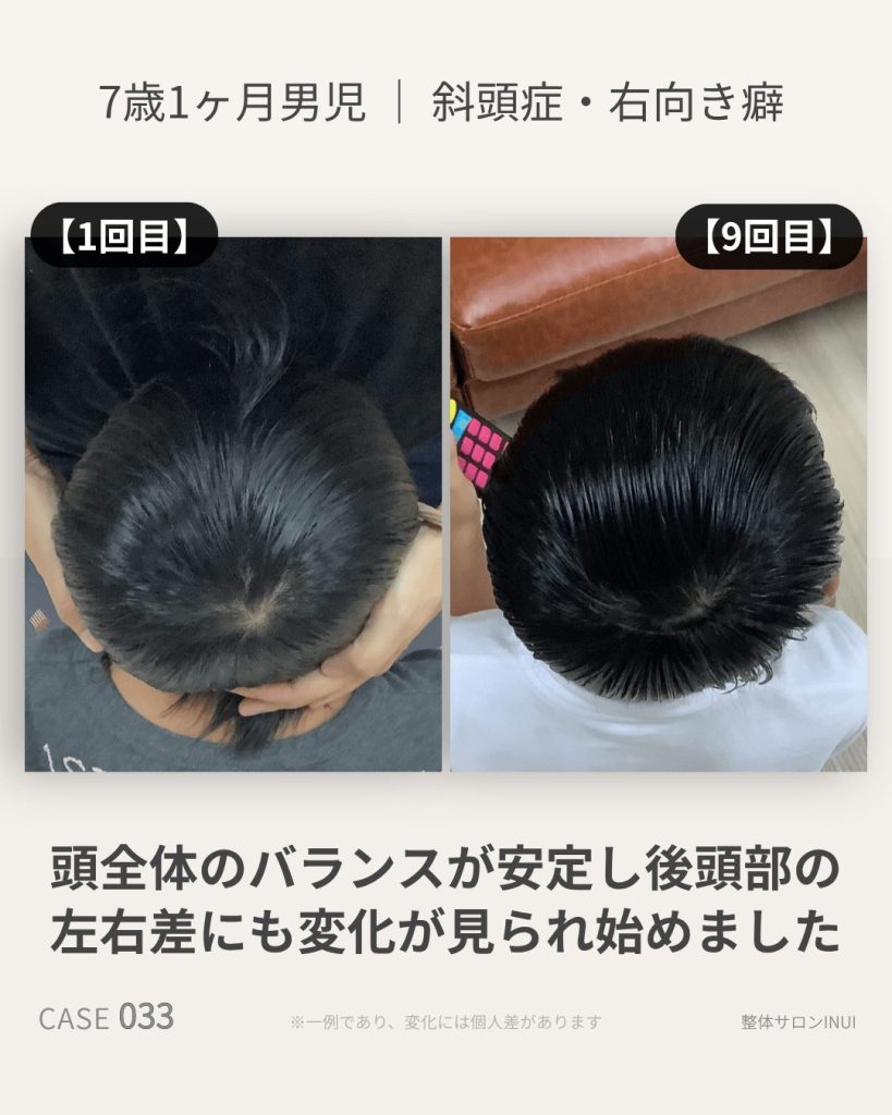 7歳1ヶ月男児の斜頭症ビフォーアフター比較