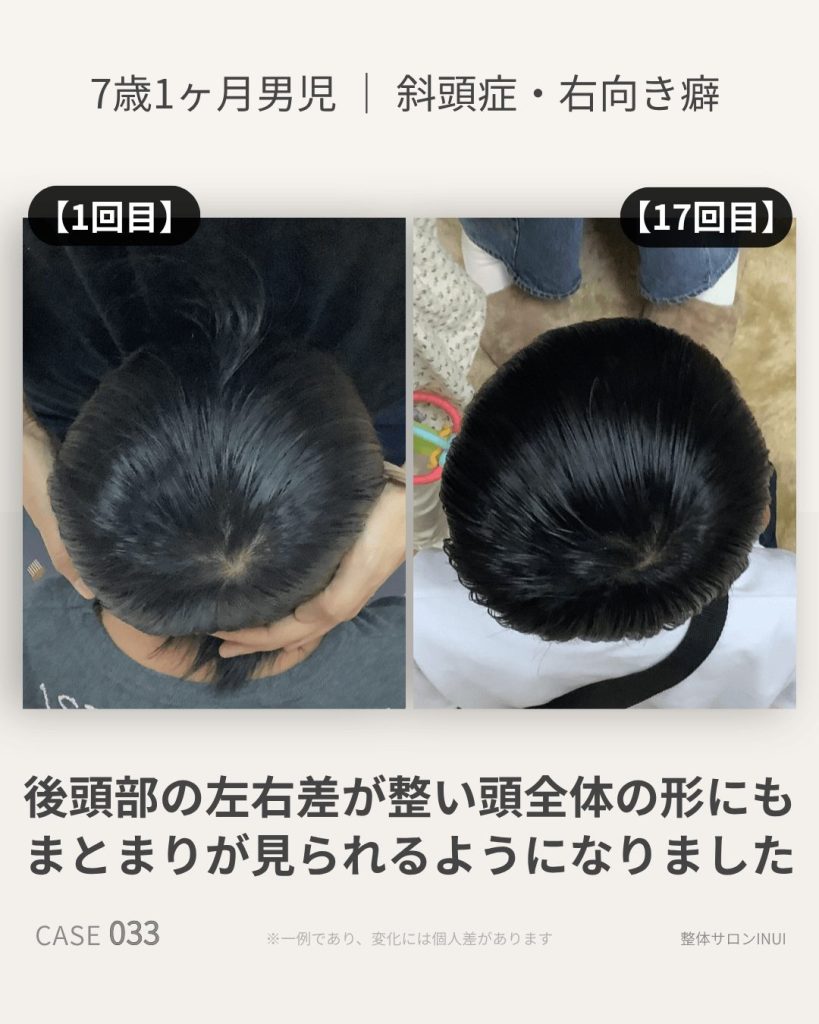 7歳1ヶ月男児の斜頭症ビフォーアフター比較