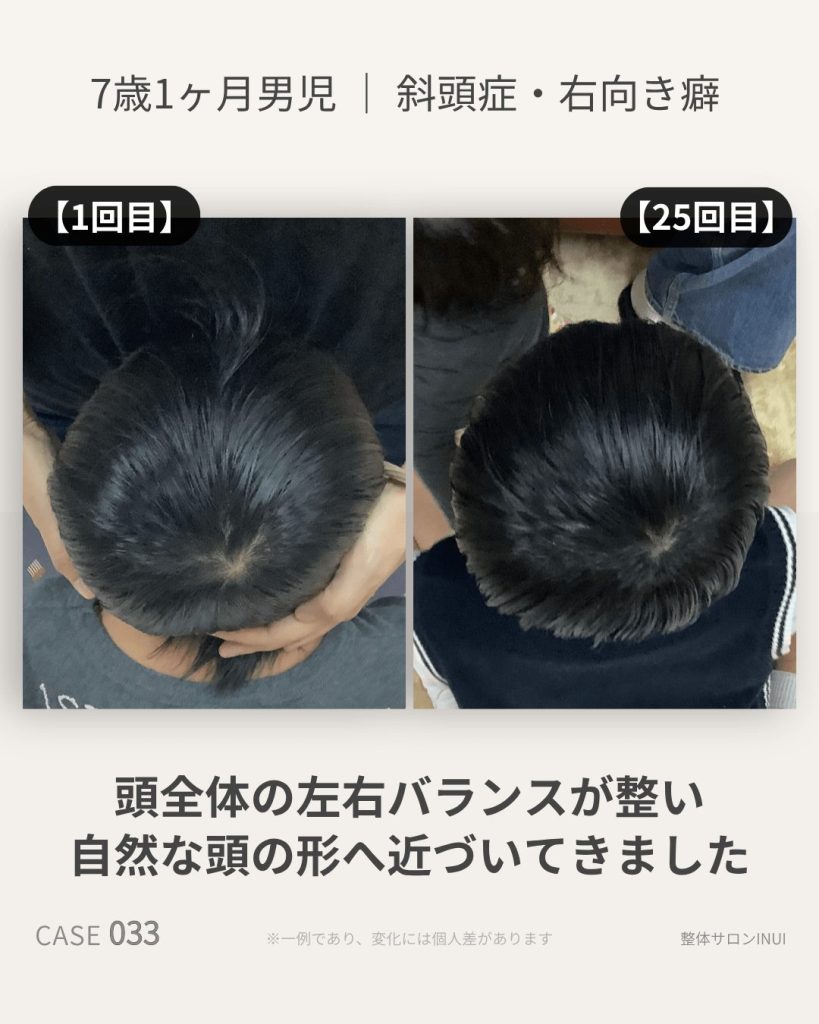 7歳1ヶ月男児の斜頭症ビフォーアフター比較