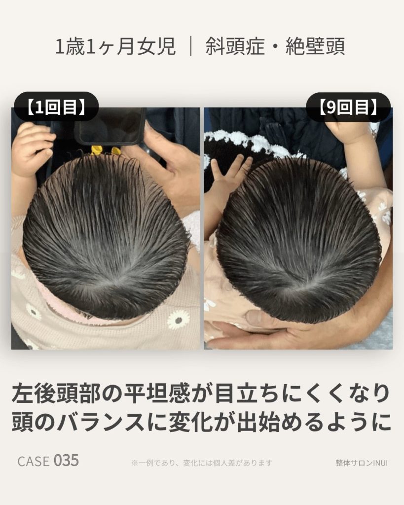 1歳1ヶ月女児の斜頭症ビフォーアフター比較