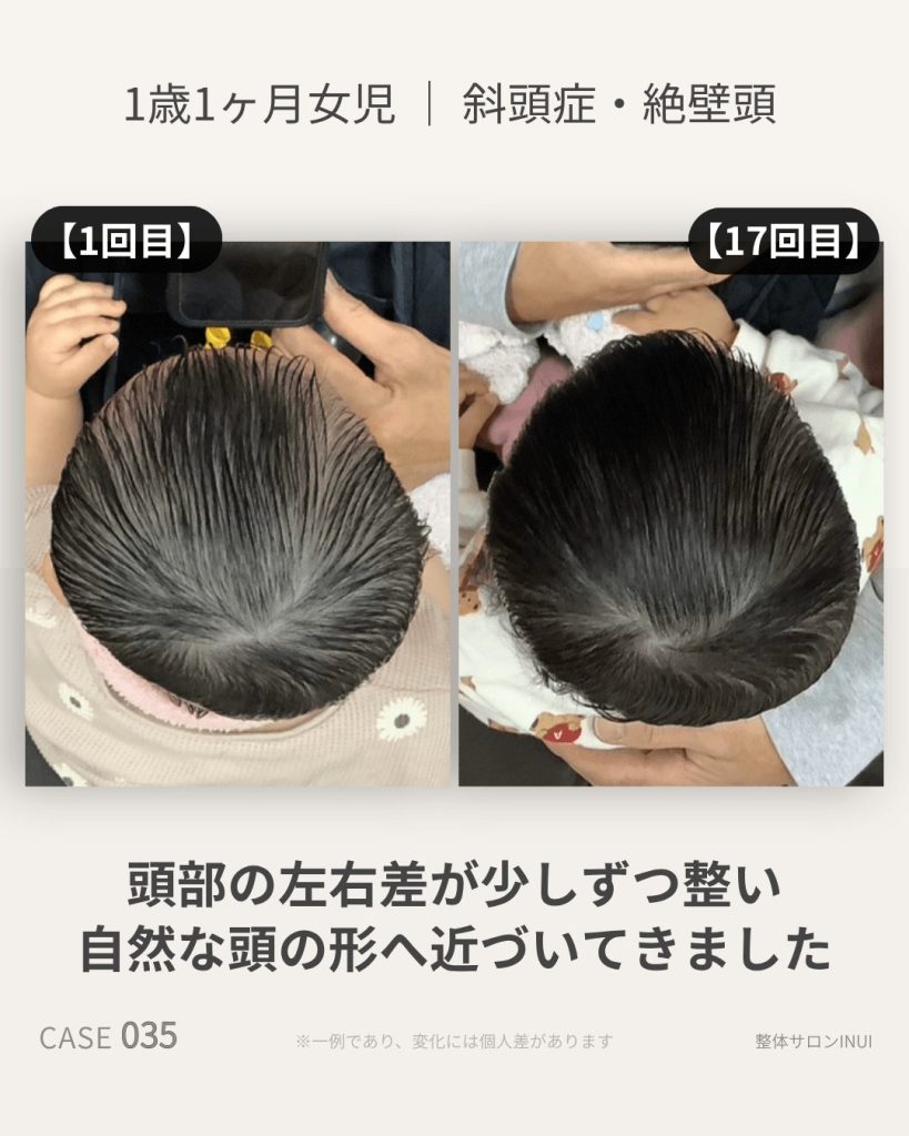 1歳1ヶ月女児の斜頭症ビフォーアフター比較