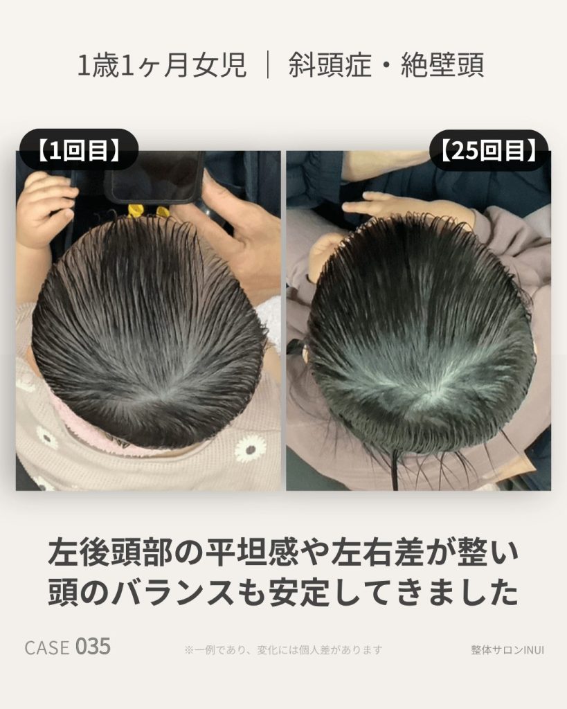 1歳1ヶ月女児の斜頭症ビフォーアフター比較