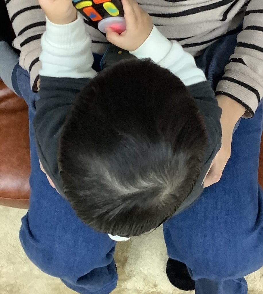 1歳2ヶ月男児の斜頭症による後頭部左右差