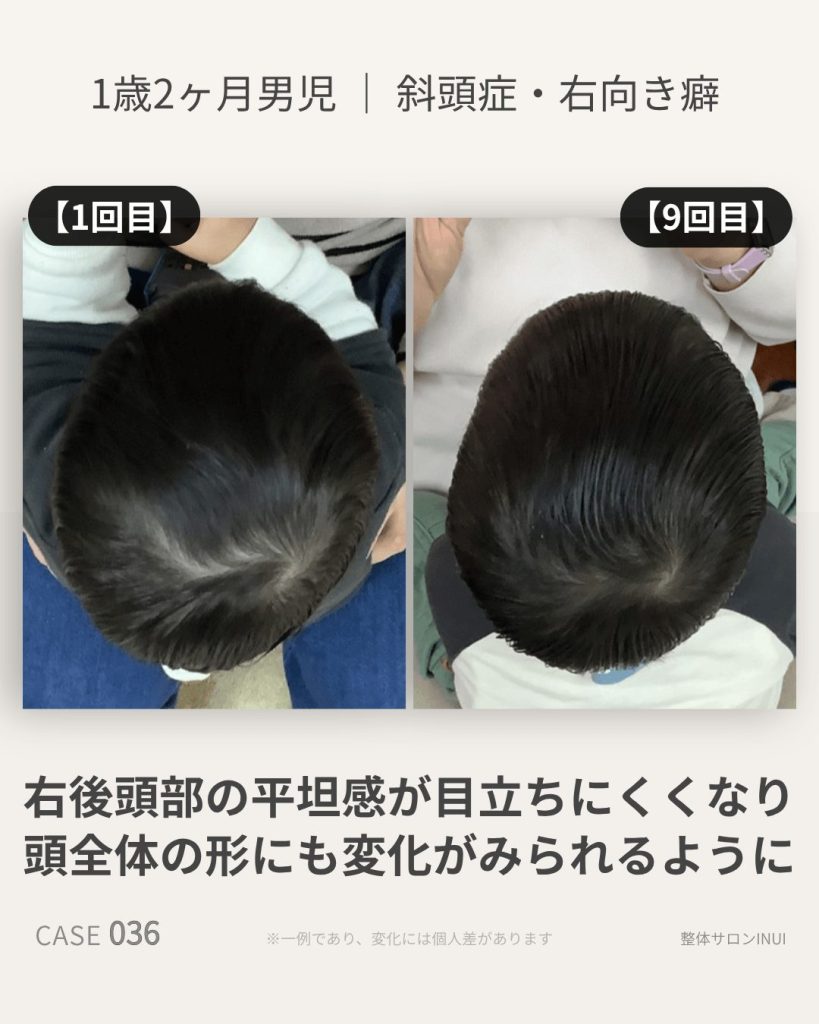 1歳2ヶ月男児の斜頭症ビフォーアフター比較