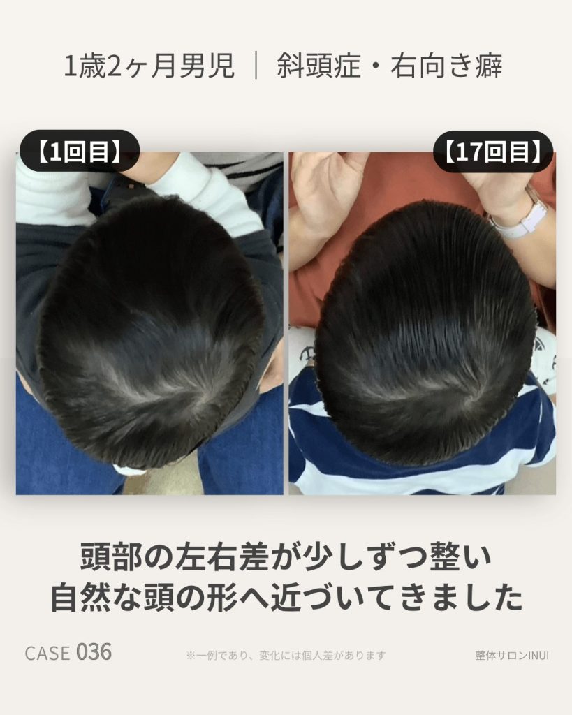 1歳2ヶ月男児の斜頭症ビフォーアフター比較