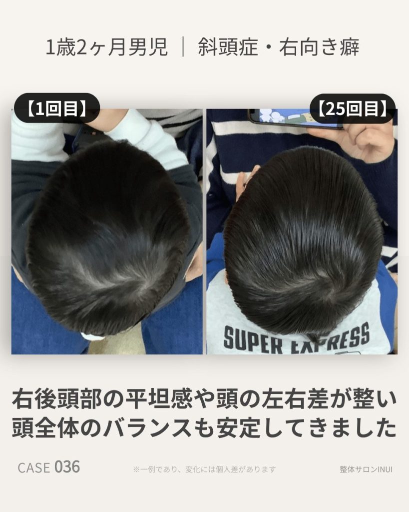 1歳2ヶ月男児の斜頭症ビフォーアフター比較