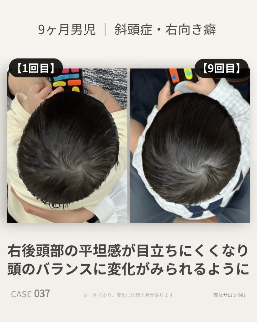 生後9ヶ月男児の斜頭症ビフォーアフター比較
