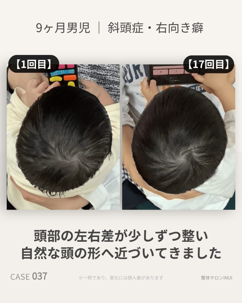生後9ヶ月男児の斜頭症ビフォーアフター比較