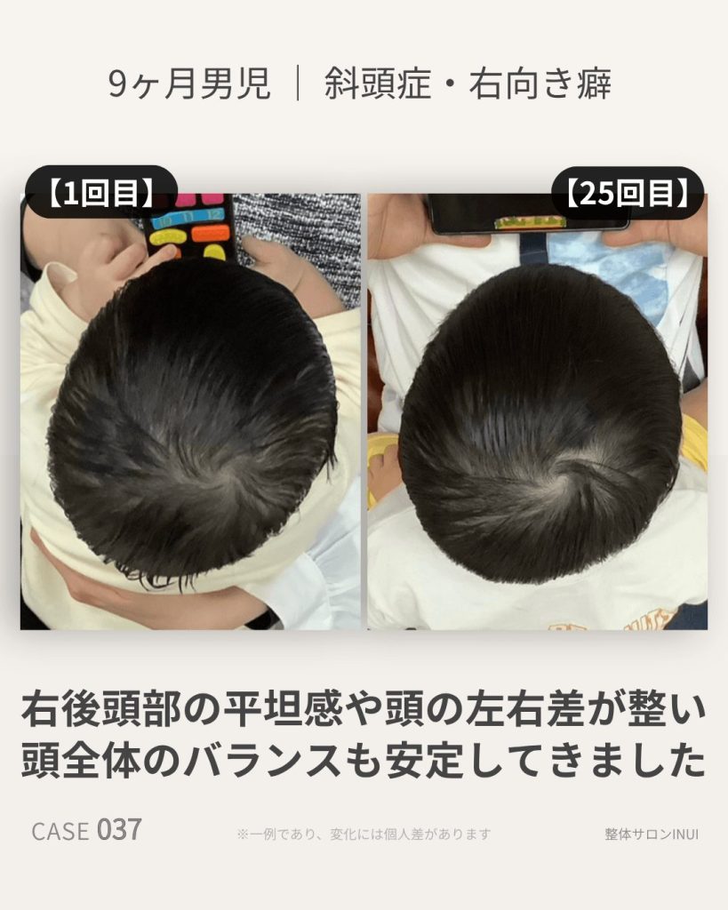 生後9ヶ月男児の斜頭症ビフォーアフター比較