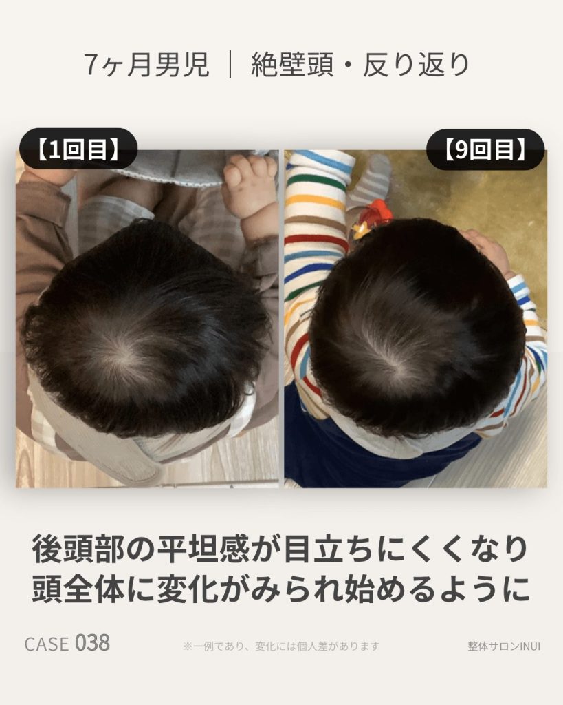 生後7ヶ月男児の絶壁頭ビフォーアフター比較