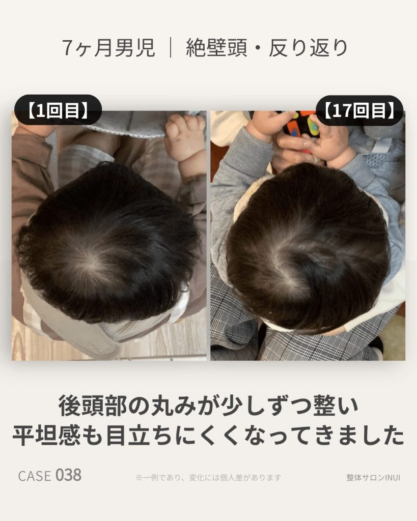 生後7ヶ月男児の絶壁頭ビフォーアフター比較