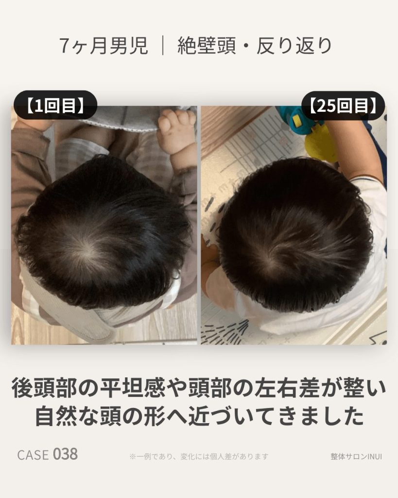 生後7ヶ月男児の絶壁頭ビフォーアフター比較