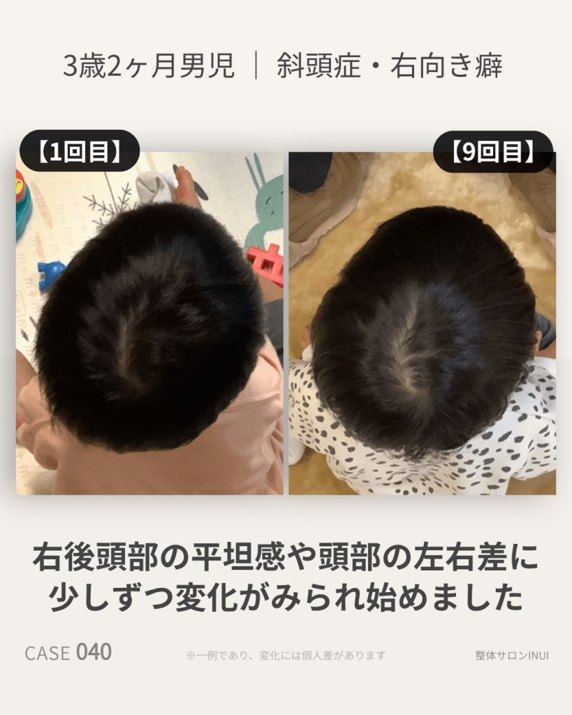 3歳2ヶ月男児の斜頭症ビフォーアフター比較