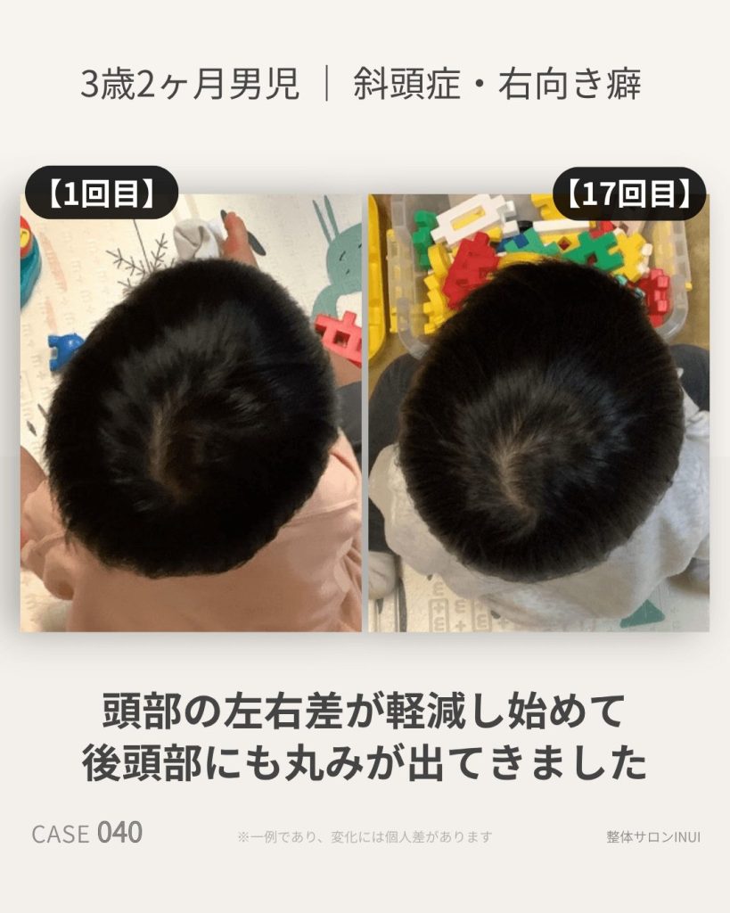 3歳2ヶ月男児の斜頭症ビフォーアフター比較