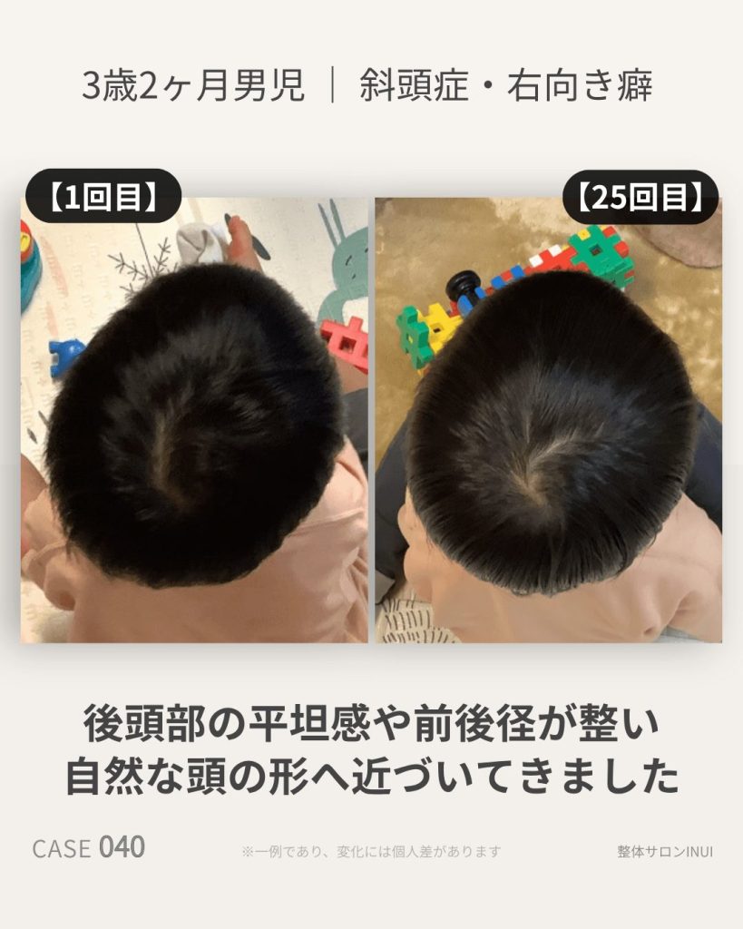 3歳2ヶ月男児の斜頭症ビフォーアフター比較