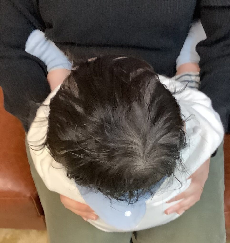 生後7ヶ月男児の斜頭症による後頭部左右差