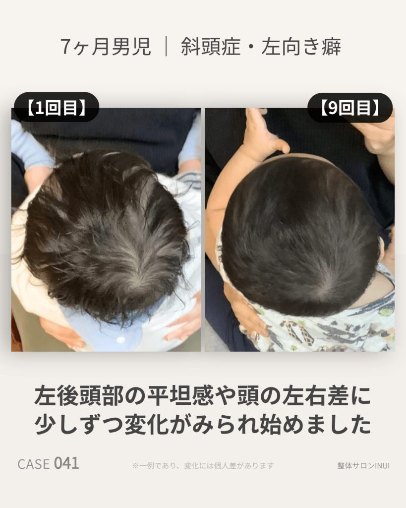生後7ヶ月男児の斜頭症ビフォーアフター比較