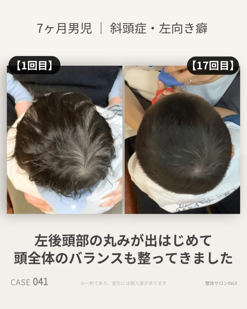 生後7ヶ月男児の斜頭症ビフォーアフター比較
