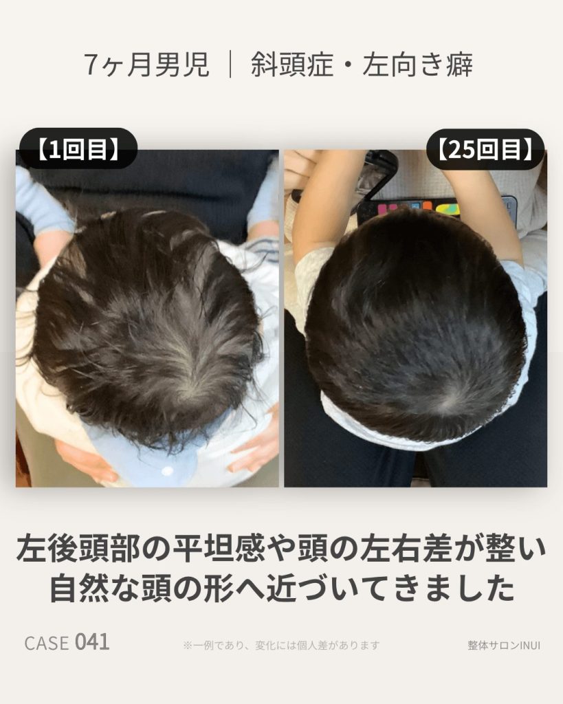 生後7ヶ月男児の斜頭症ビフォーアフター比較