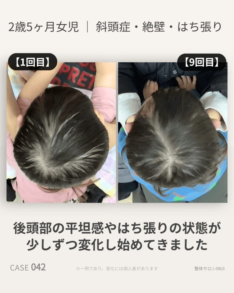 2歳5ヶ月女児の斜頭症ビフォーアフター比較