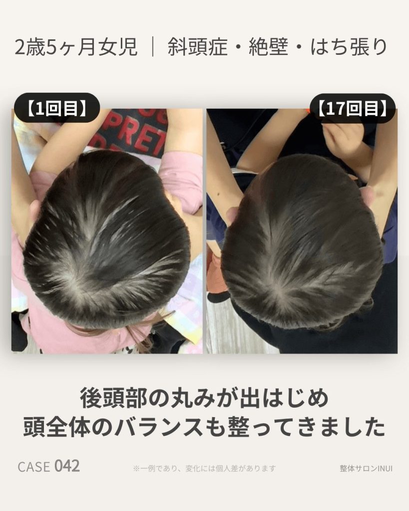 2歳5ヶ月女児の斜頭症ビフォーアフター比較