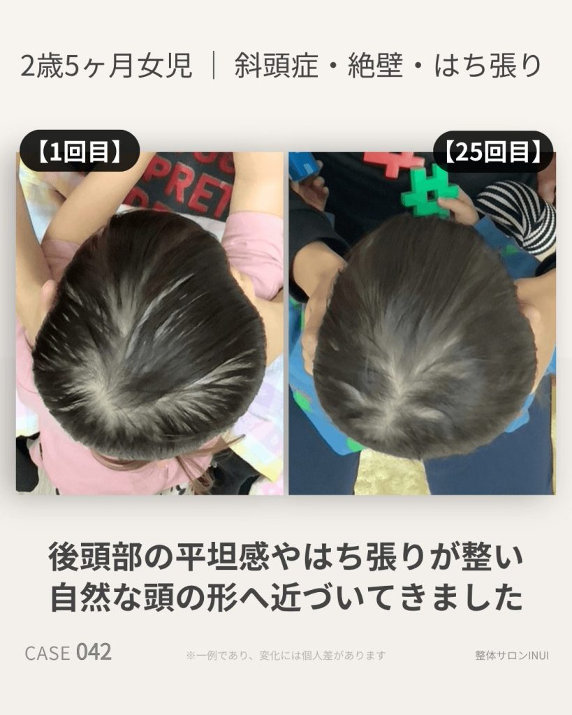 2歳5ヶ月女児の斜頭症ビフォーアフター比較