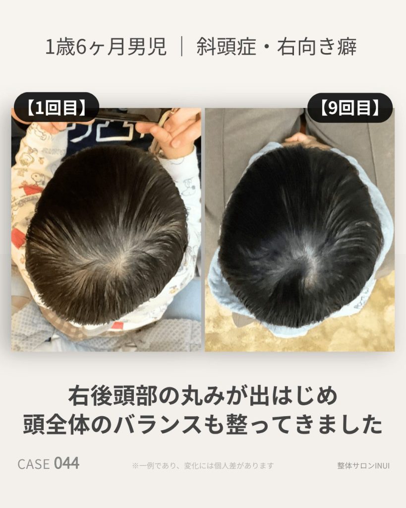 1歳6ヶ月男児の斜頭症ビフォーアフター比較