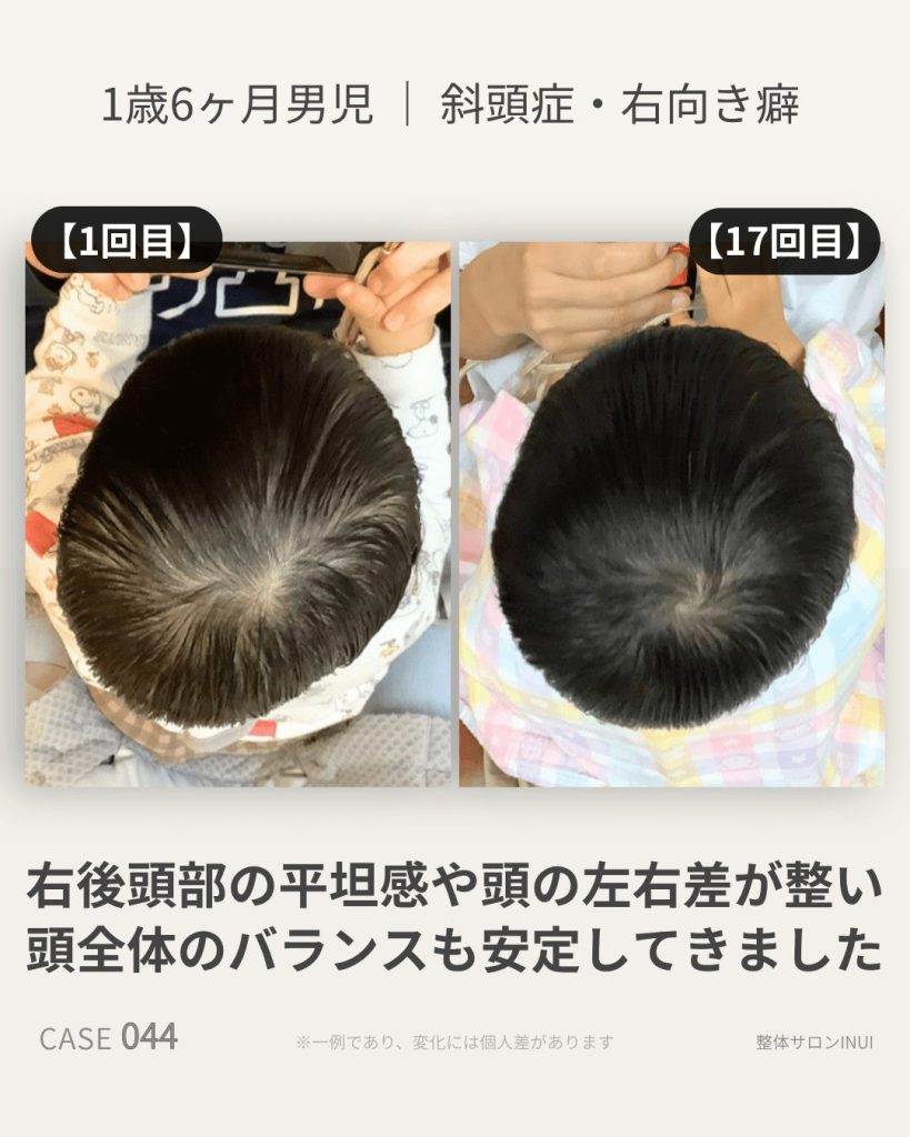 1歳6ヶ月男児の斜頭症ビフォーアフター比較
