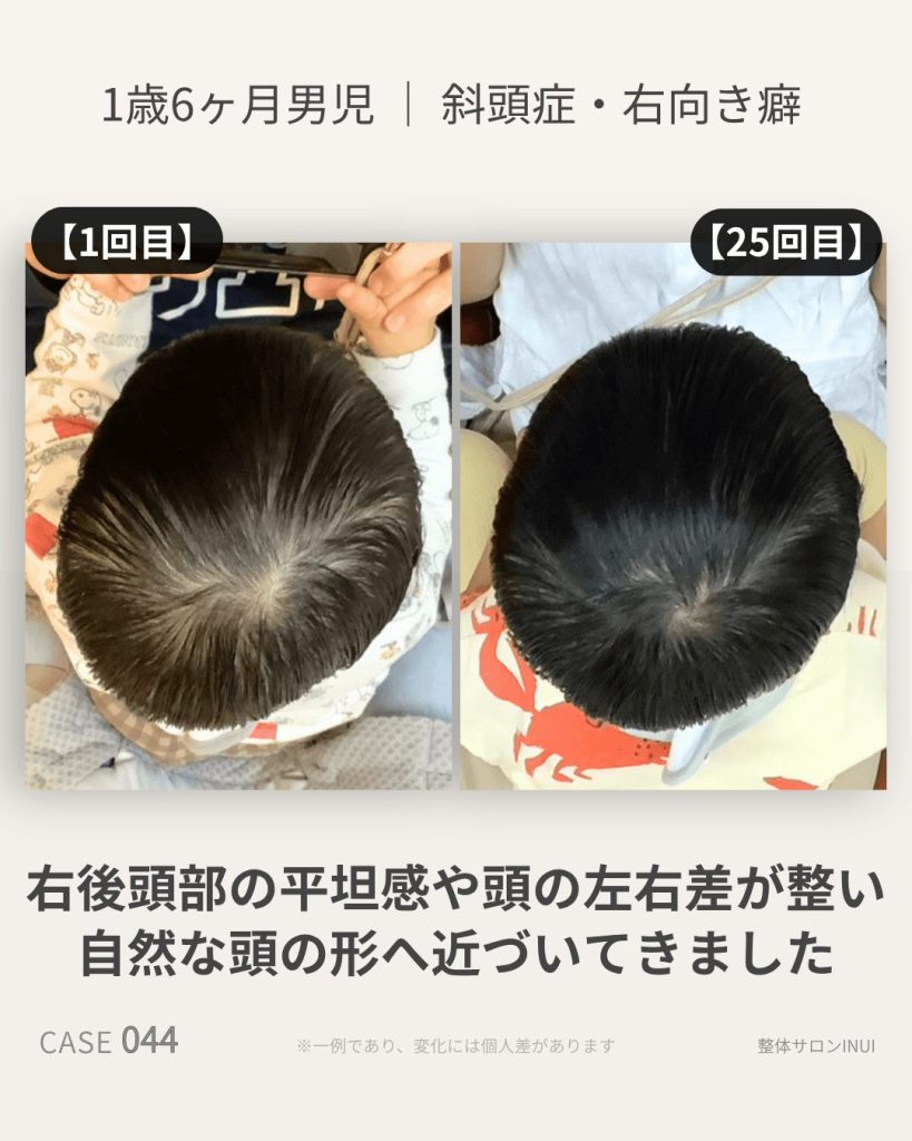 1歳6ヶ月男児の斜頭症ビフォーアフター比較