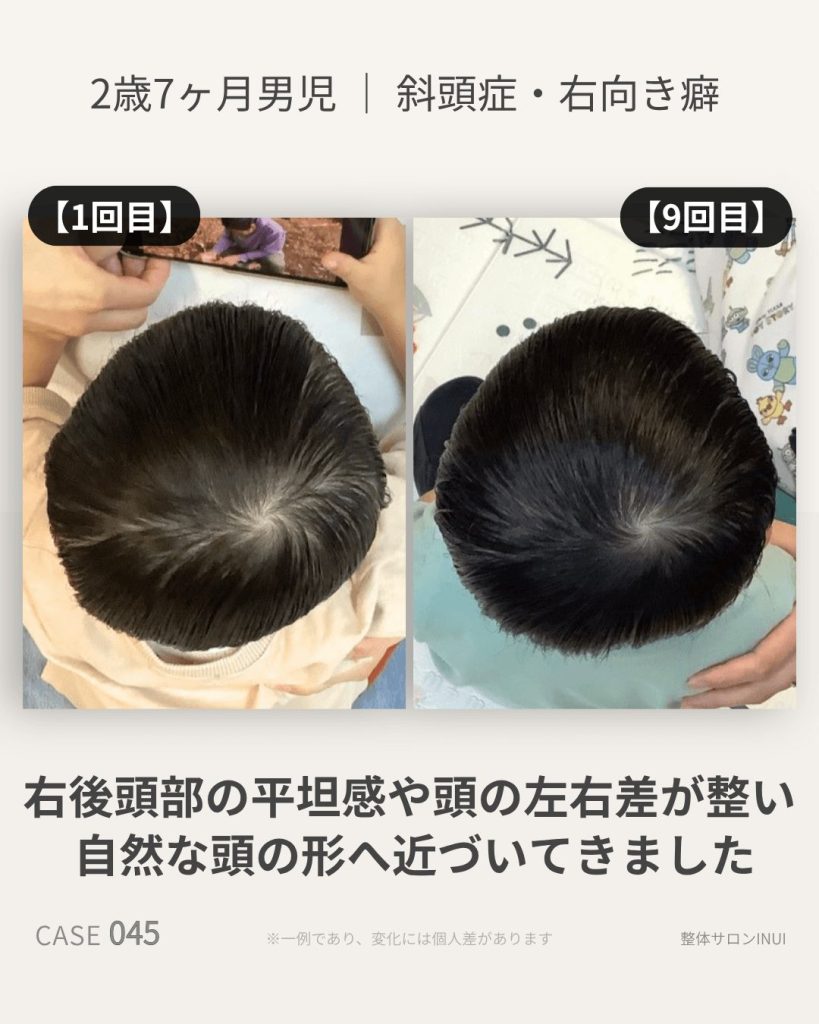 2歳7ヶ月男児の斜頭症ビフォーアフター比較