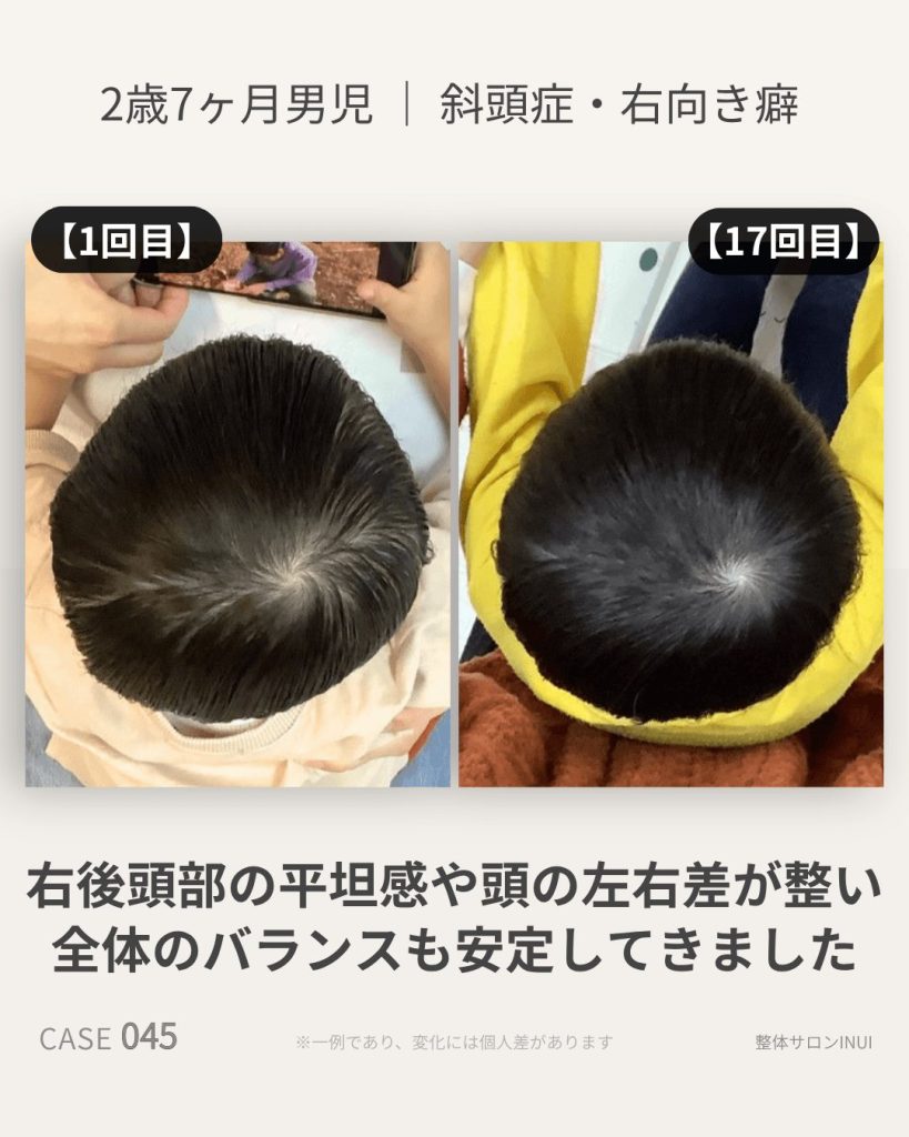 2歳7ヶ月男児の斜頭症ビフォーアフター比較