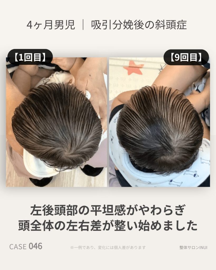 生後4ヶ月男児の斜頭症ビフォーアフター比較