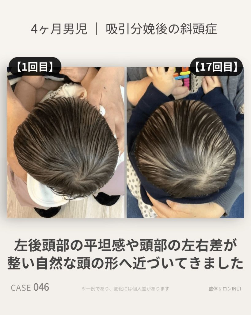 生後4ヶ月男児の斜頭症ビフォーアフター比較
