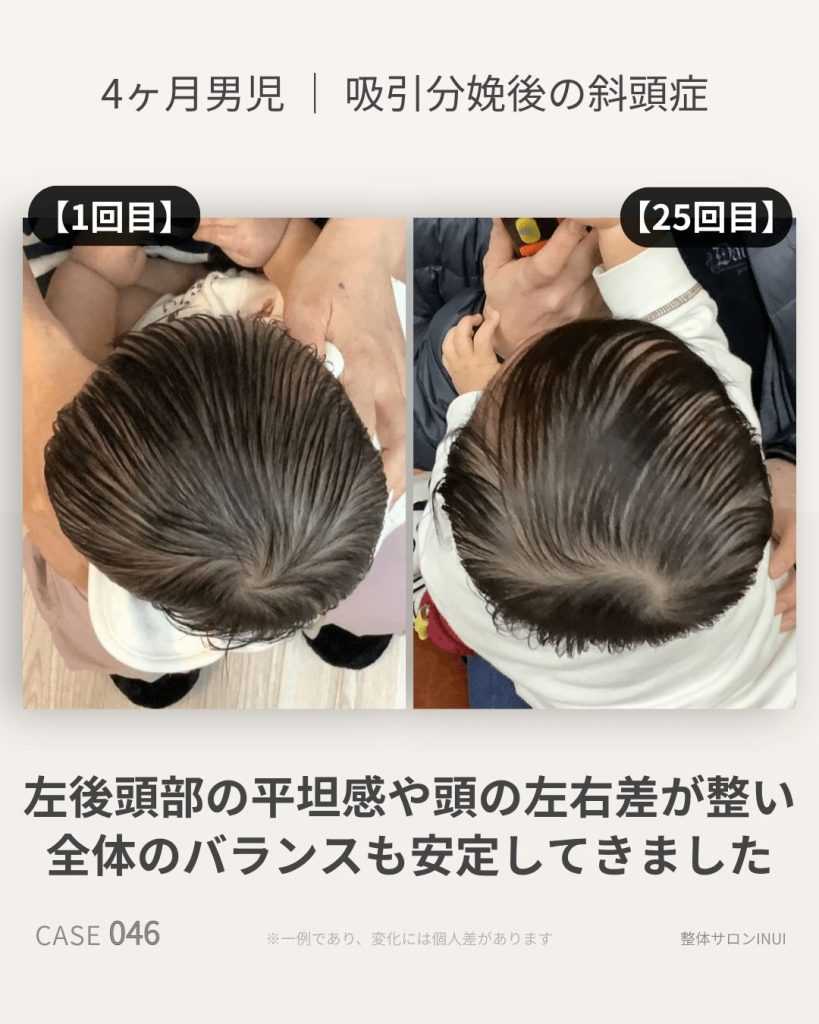 生後4ヶ月男児の斜頭症ビフォーアフター比較