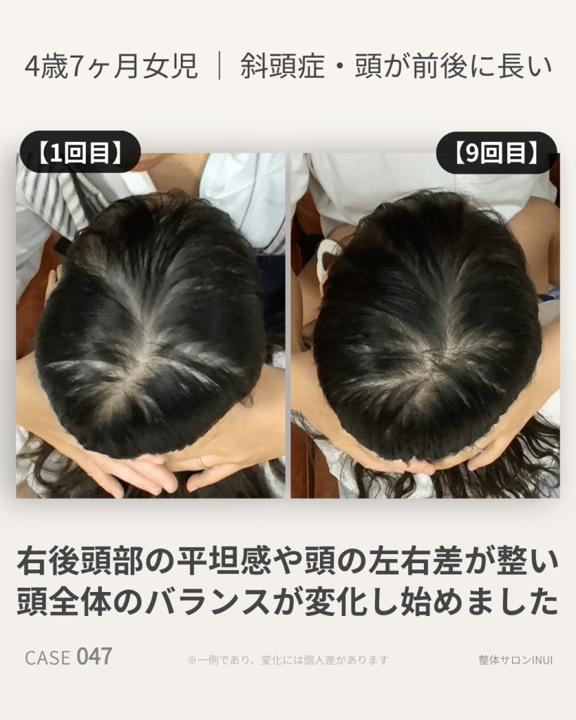 4歳7ヶ月女児の斜頭症ビフォーアフター比較