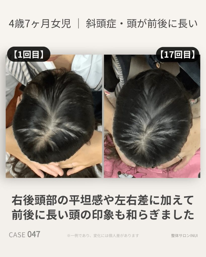 4歳7ヶ月女児の斜頭症ビフォーアフター比較