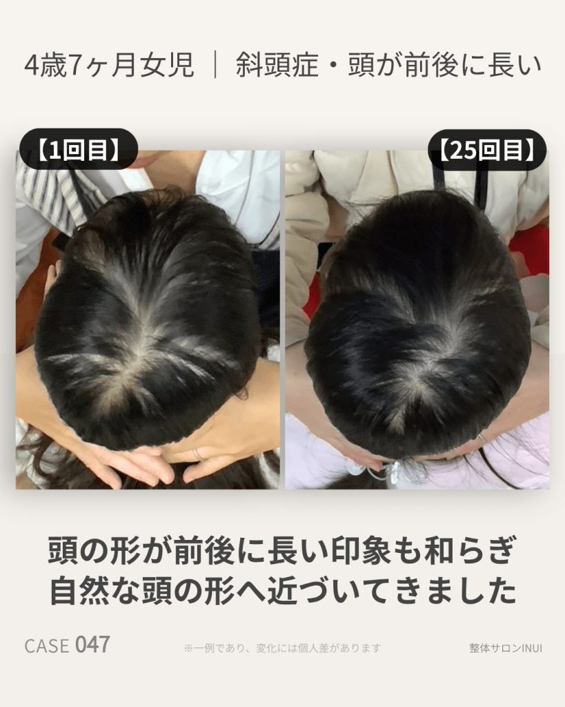4歳7ヶ月女児の斜頭症ビフォーアフター比較