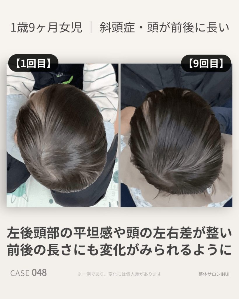 1歳9ヶ月女児の斜頭症ビフォーアフター比較