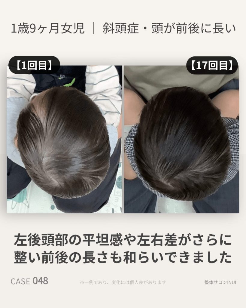 1歳9ヶ月女児の斜頭症ビフォーアフター比較