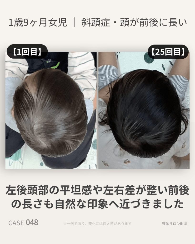 1歳9ヶ月女児の斜頭症ビフォーアフター比較