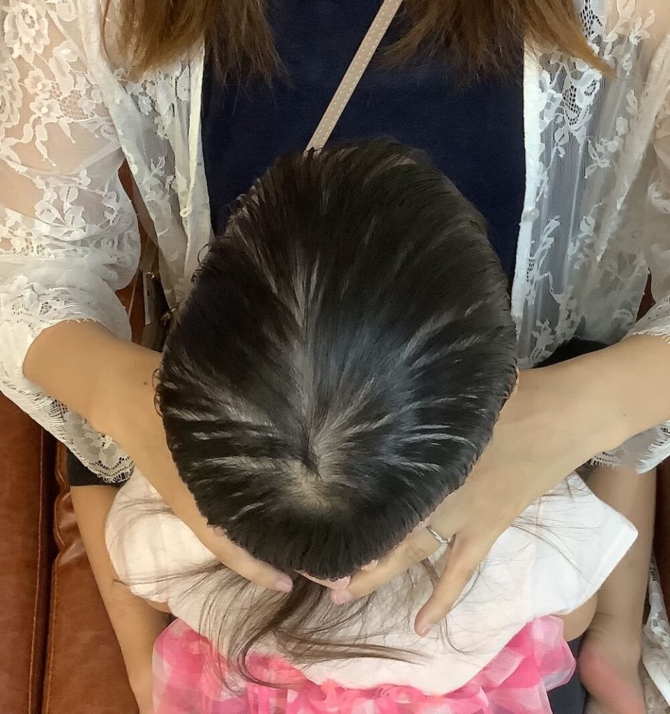 3歳9ヶ月女児の斜頭症による後頭部左右差