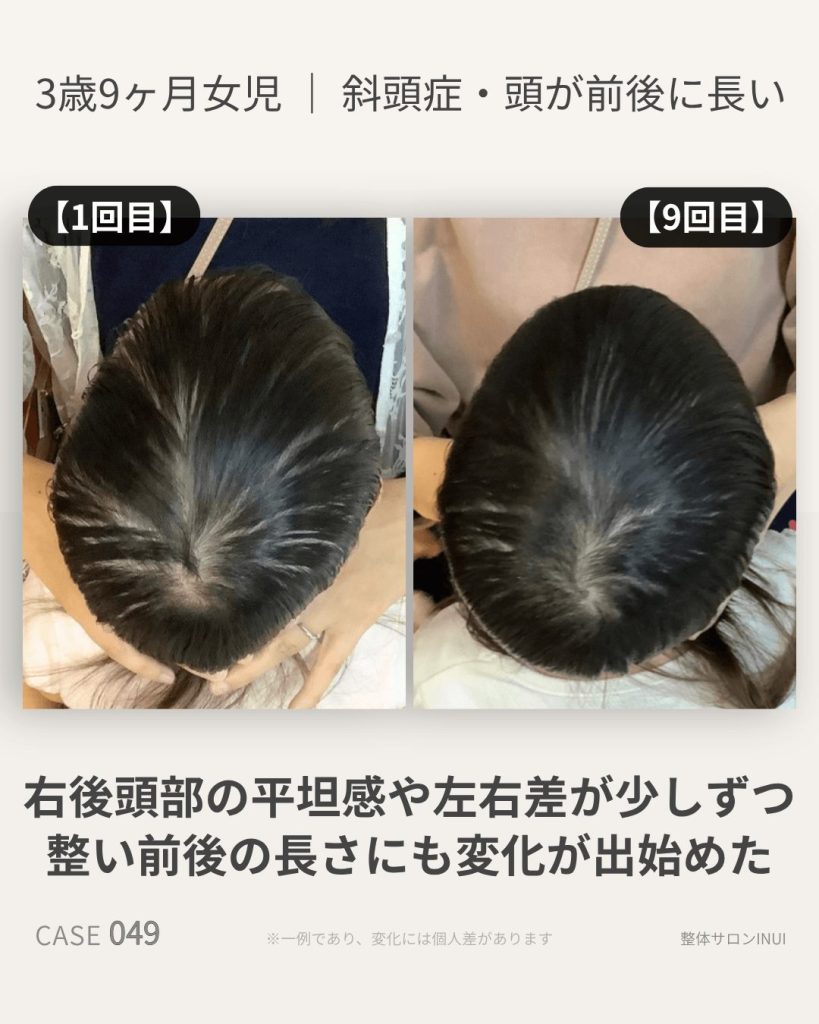 3歳9ヶ月女児の斜頭症ビフォーアフター比較