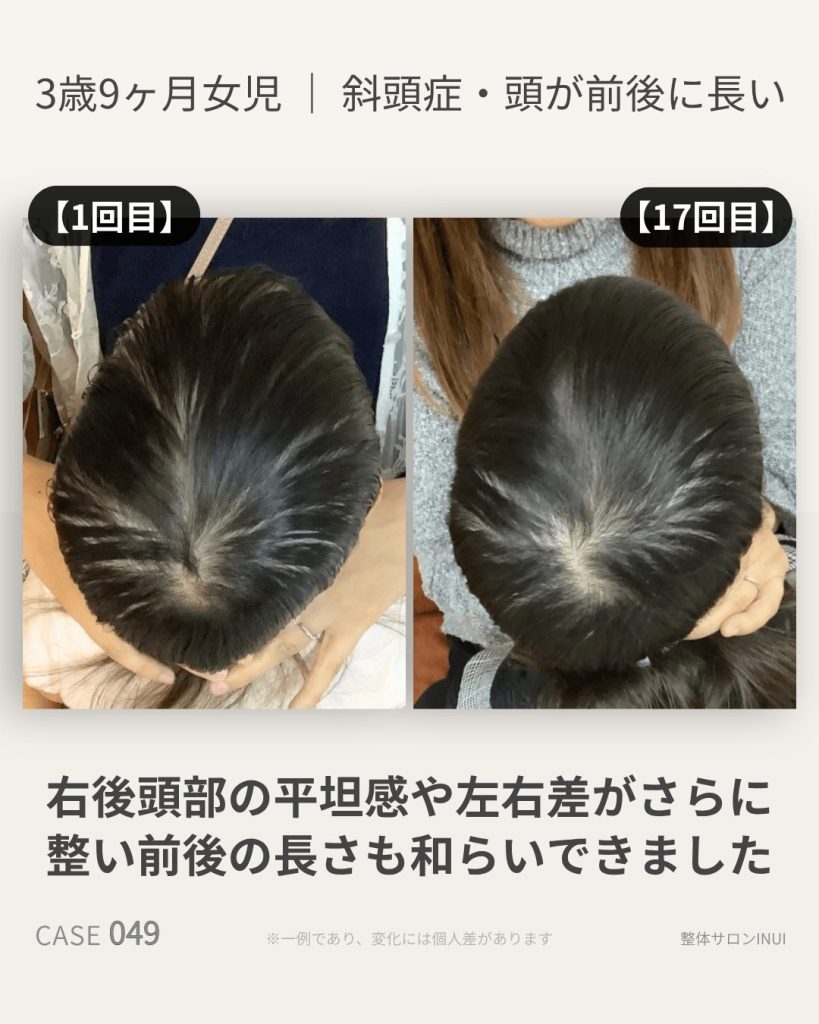3歳9ヶ月女児の斜頭症ビフォーアフター比較