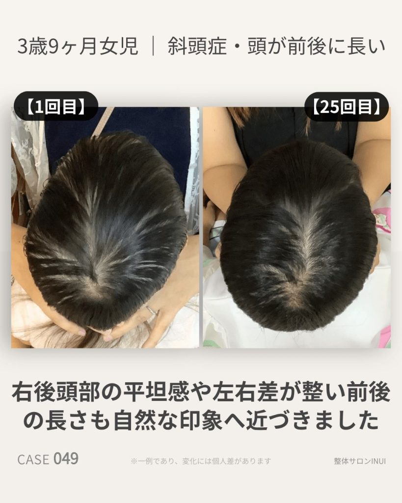 3歳9ヶ月女児の斜頭症ビフォーアフター比較
