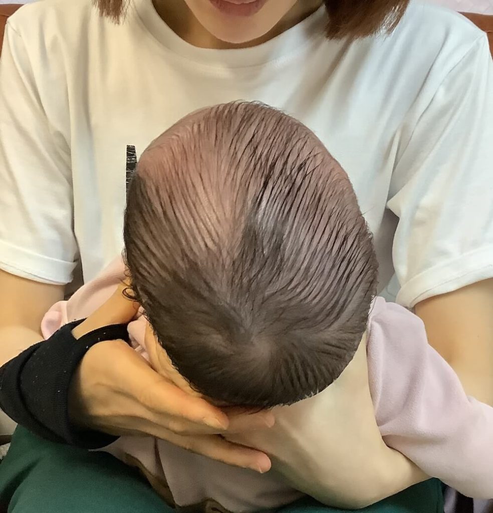 生後3ヶ月女児の斜頭症による後頭部左右差