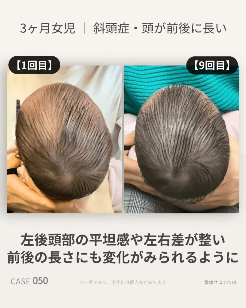 生後3ヶ月女児の斜頭症ビフォーアフター比較