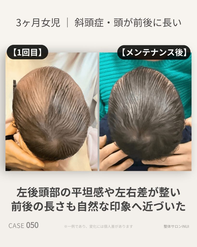 生後3ヶ月女児の斜頭症ビフォーアフター比較